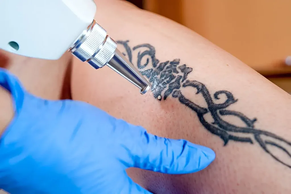 Is Laser Tattoo Removal Worth the Cost