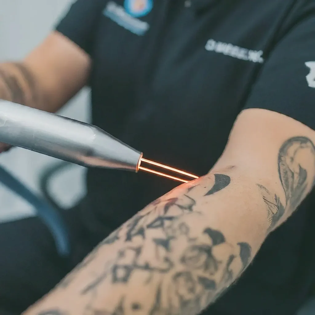 Tattoo Removal Options