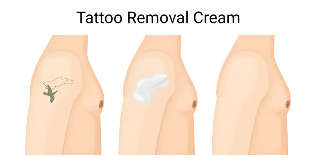 Tattoo Removal Creams 1