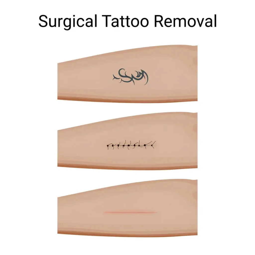 Tattoo removal Surgical Excision